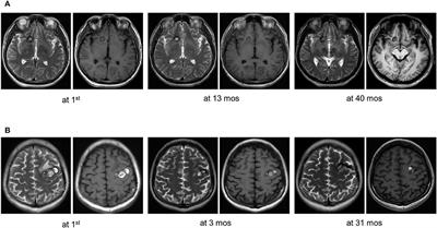 Simplex cerebral cavernous malformations with MAP3K3 mutation have distinct clinical characteristics